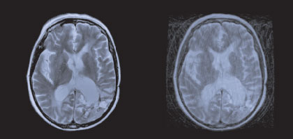 High Definition MRI Scan comparison