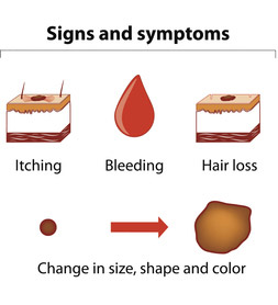 Melanoma signs and symptoms