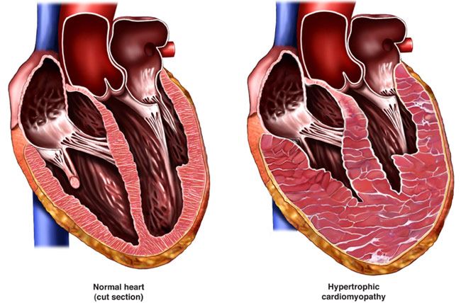 Inherited Cardiovascular Disease Hypertrophic Cardiomyopathy