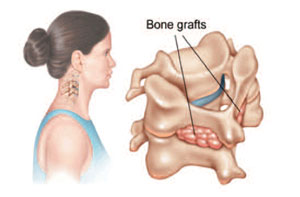 Bone grafts