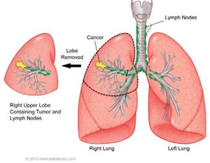 Lobectomy