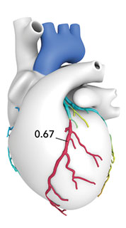 stylized heart from FFR-CT scan