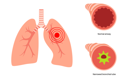 illustration of asthma - showing the lungs and a normal airway vs a narrowed bronchial tube