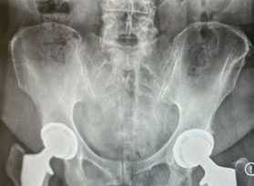 X-ray of double hip replacement