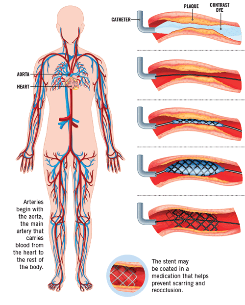 illustration of clogged artery and catheter