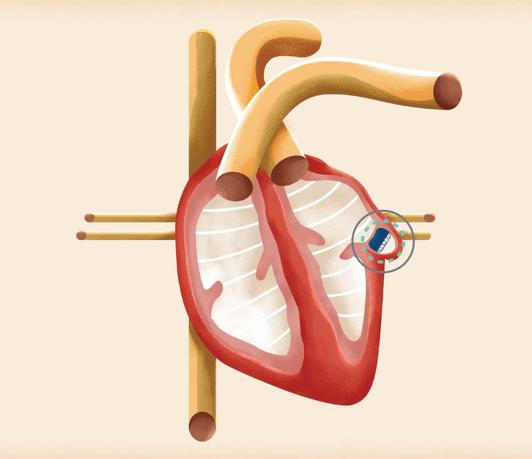 The Watchman is a self-expanding device that closes the heart’s left atrial appendage, blocking clots from escaping.