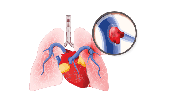 A pulmonary embolism occurs when a blockage such as a blood clot hinders blood flow in an artery to the lungs