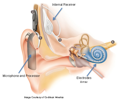 Cochlear Implant in Ear
