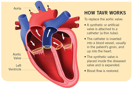 illustration of how the TAVR procedure works 
