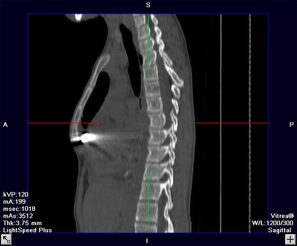 CT Image (Sagittal View), After Repair