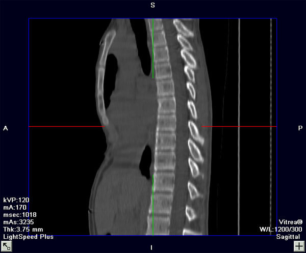 CT Image (Sagittal View), Before Repair
