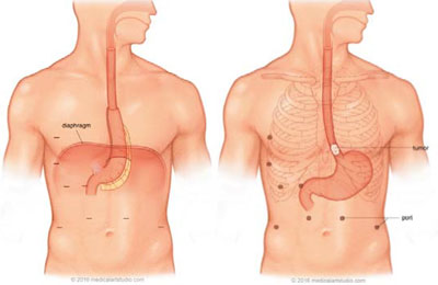 Esophagectomy