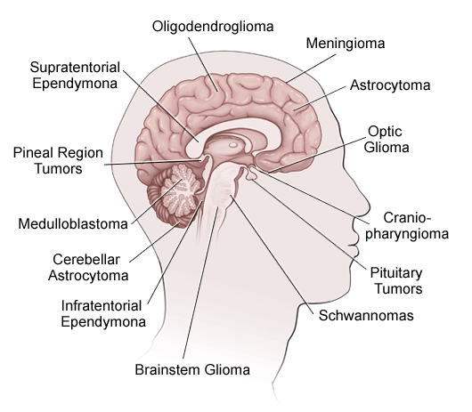 Benign Brain Tumor Size Chart