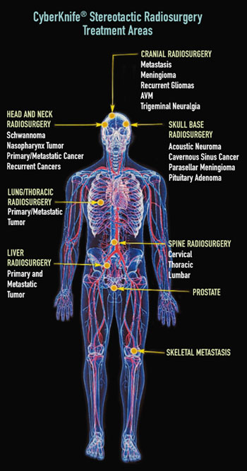 cyberknife treatment areas