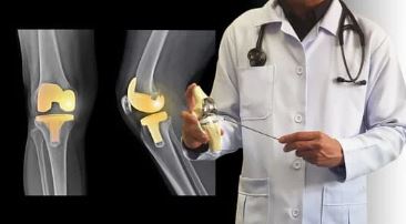 A Better Health Program: Dessert & Coffee with Michael R. Duch, MD, on Hip and Knee Replacements - RWJUH Hamilton