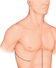 Esophagectomy