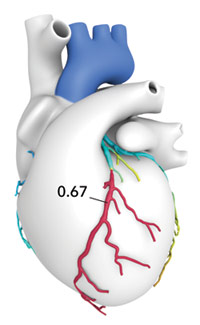 HeartFlow Analysis FFR-CT 