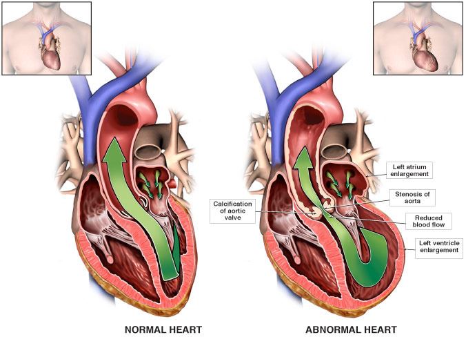 Aortic Stenosis Treatment In New Jersey Heart And Vascular Care