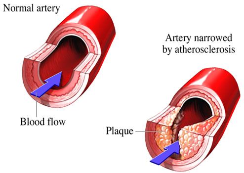 Atherosclerosis