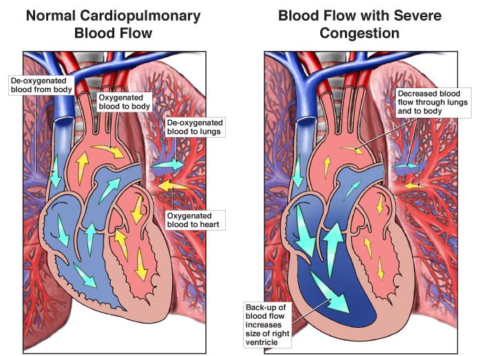 Cardiac Edema