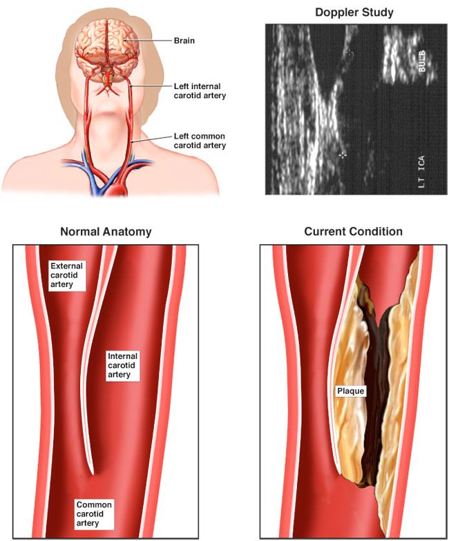 Ellendig Zorg kubus What is carotid artery disease?
