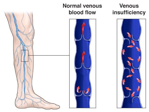 Chronic Venous Insufficiency (CVI) of Aescin Supplement Chronic Venous Insufficiency (CVI) of Aescin Supplement