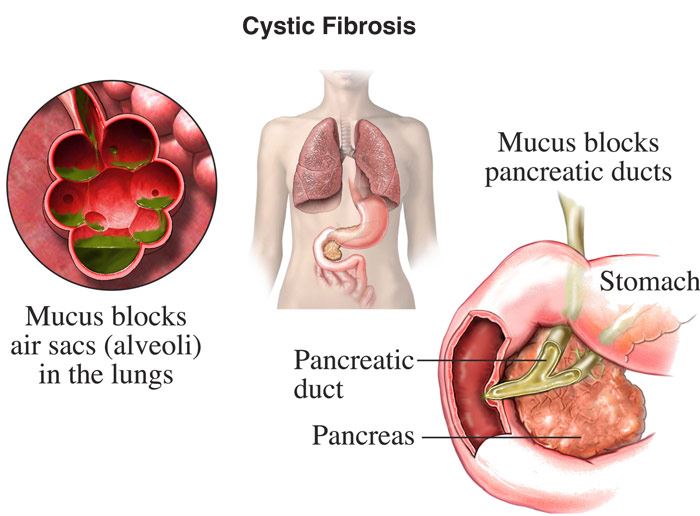 Cystic Fibrosis