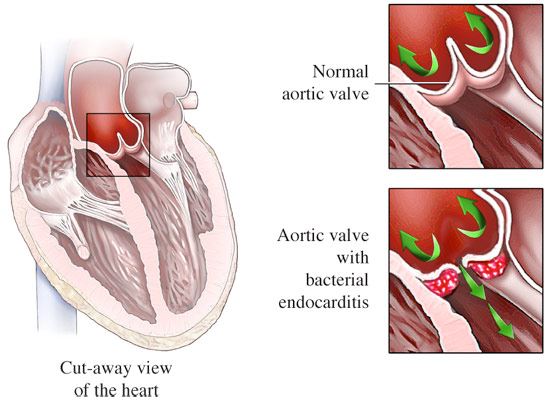 Endocarditis