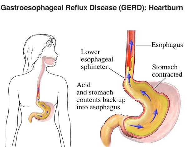 Role of Multimodality Imaging in Gastroesophageal Reflux Disease and Its  Complications, with Clinical and Pathologic Correlation | RadioGraphics