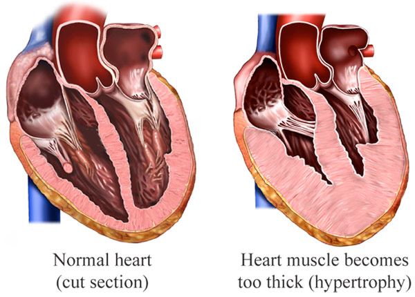 Treating heart failure in New Jersey