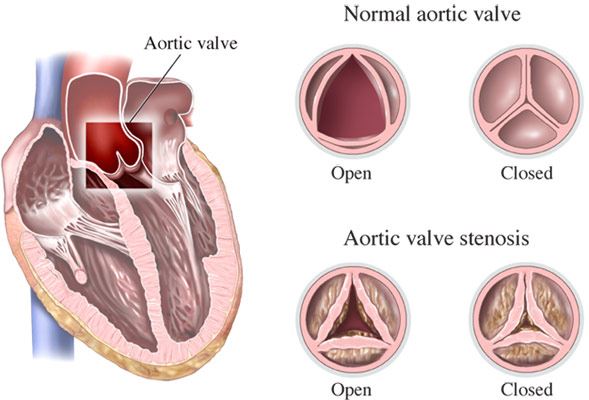 Heart Valve Disease