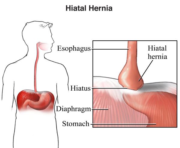 Hernia: What it is, Symptoms, Types, Causes & Treatment