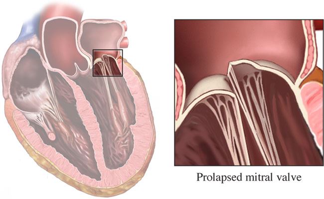 Mitral Valve Disease Mitral valve prolapse