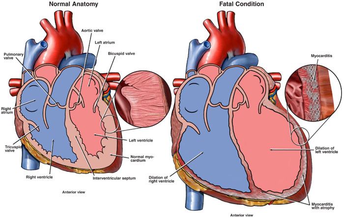 Myocarditis Diagnosis Symptoms And Treatment