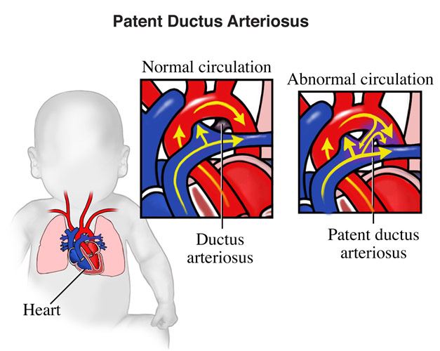 Pathophysiology Of Patent Ductus Arteriosus