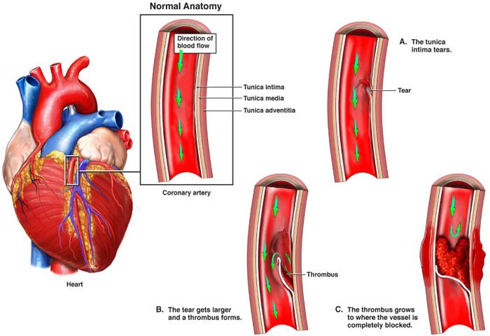 Spontaneous Coronary Artery Dissection SCAD