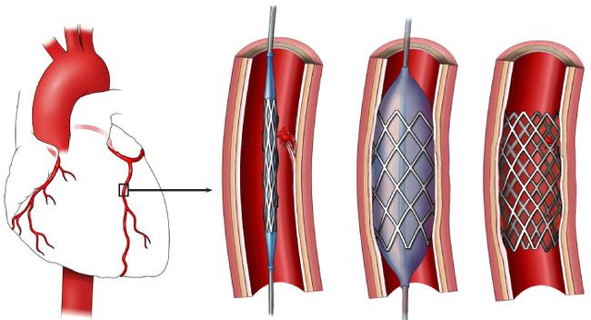 Stent Placement