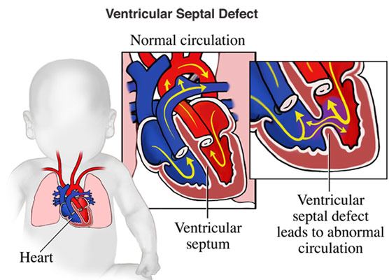 Ventricular septal defect