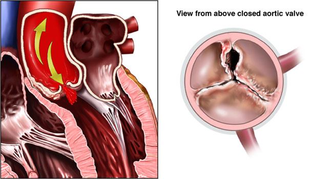 Aortic valve disease