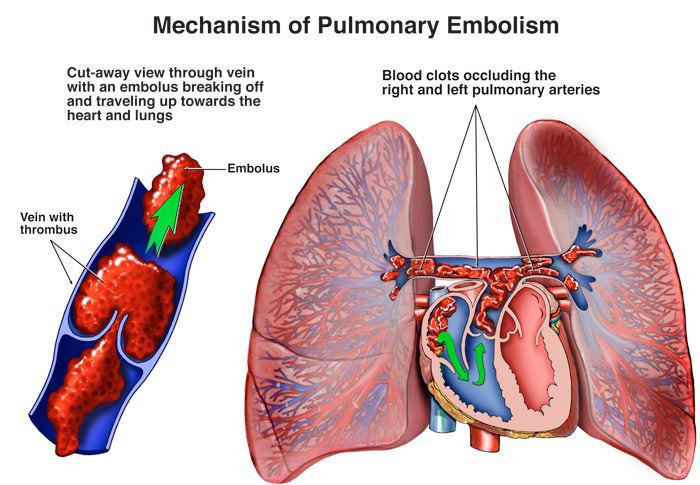 Pulmonary Embolism Treatment in New Jersey | Lung, Vascular Care