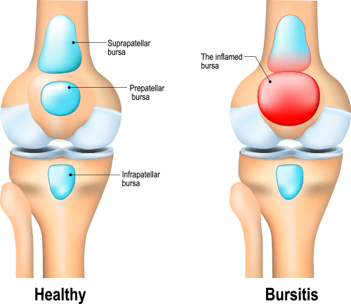 illustrations of two knees - one healthy knee and one knee with bursitis