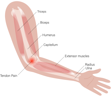 Golfer's elbow